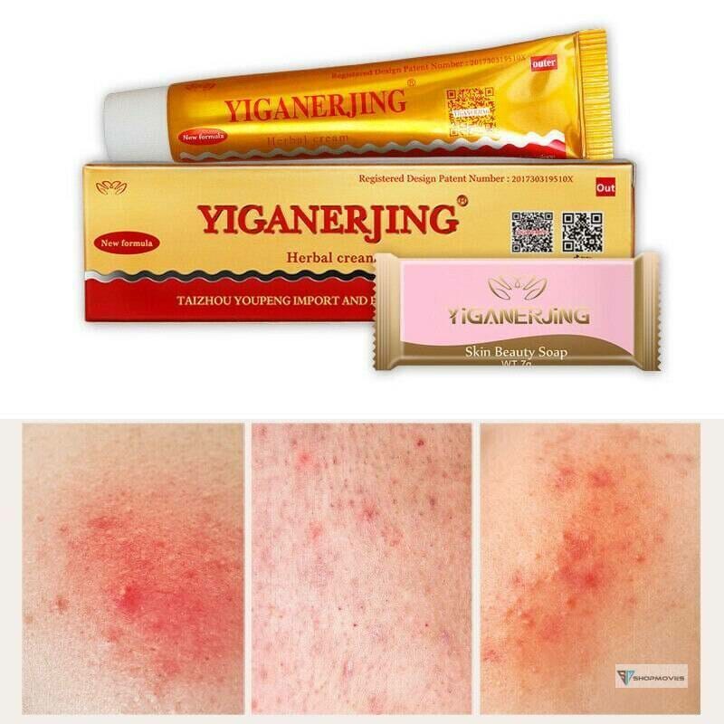 YIGANERJING (without retail box) Skin Psoriasis Cream Dermatitis Eczematoid Eczema Ointment Bags Fashion Women's Fashion size: 1