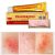 YIGANERJING (without retail box) Skin Psoriasis Cream Dermatitis Eczematoid Eczema Ointment